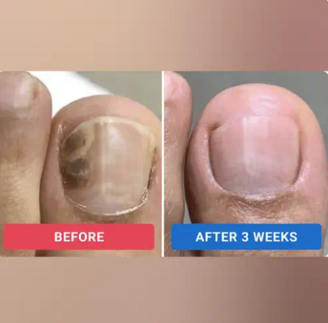 NailFix™ - Fungal Nail Renewal Patches